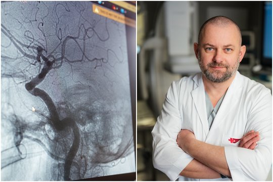 Smegenų aneurizma: gydytojas atsakė, kada nereikia operacijos