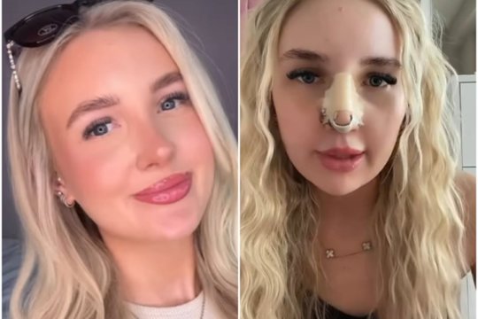 Dėl populiaraus vaisto moters nosyje atsivėrė centimetro dydžio skylė: perspėja visus