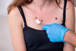 Kiek apgamų yra normalu? Gydytojas įvardijo ribą, kada didėja rizika