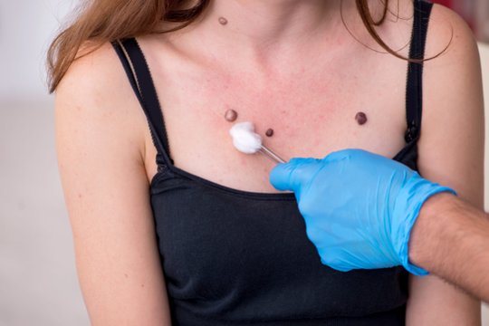 Kiek apgamų yra normalu? Gydytojas įvardijo ribą, kada didėja rizika