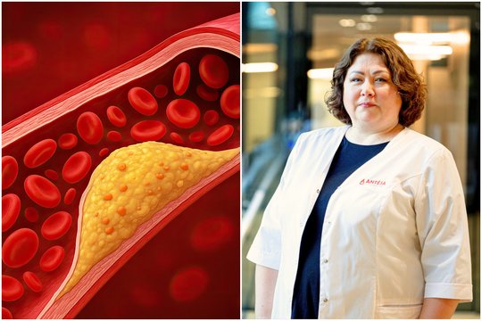Gydytoja apie svarbaus organo sutrikimą: kartais vienintelis požymis – padidėjęs cholesterolis