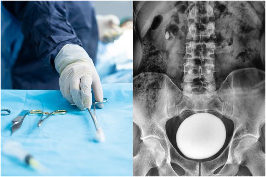  Vyro šlapimo pūslėje – į kiaušinį panašus radinys: nustebo net daug matę gydytojai