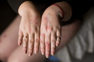 Dilgėlinė – kaip atpažinti ir kaip suvaldyti?