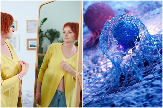 Kasos vėžys išsiduoda neįprastu simptomu – reikia pasižiūrėti į veidrodį