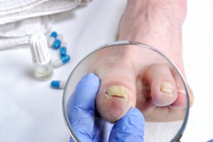 Pakito pėdų oda ar nagai? Vaistininkė paaiškino, kada tai gali būti grybelis