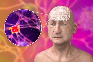 Bliūkšta viltys dėl vaistų nuo Alzheimerio ligos