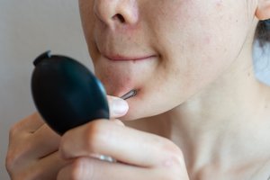 Slapti aknės sukėlėjai: gydytoja pasakė, kada reikalingi kraujo tyrimai