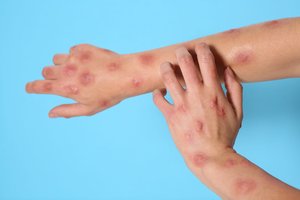 Paaiškėjo daugiau detalių apie b raupų atvejį Lietuvoje
