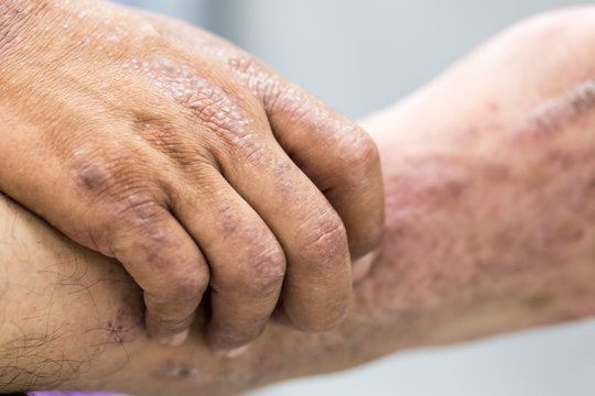 Slaugos ligoninėje Klaipėdoje įtaria plintant užkrečiamą ligą: pasibaisėjo atsakingų asmenų abejingumu