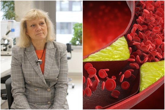 9 iš 10 lietuvių daro šią klaidą: dėl jos kraujagyslėse kaupiasi cholesterolis