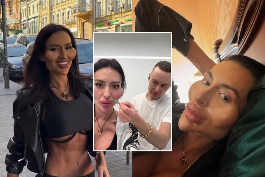 Didžiausių skruostų pasaulyje savininke praminta ukrainietė ryžosi netikėtiems pokyčiams