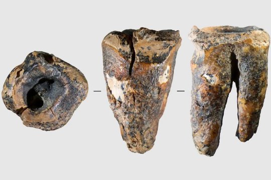 Netikėta: dantų gydymu užsiėmė jau neandertaliečiai