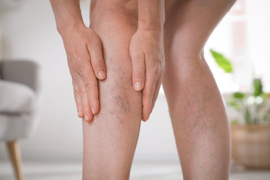 Venų varikozė – tik estetinė problema? Atskleidė, kada ši liga gali baigtis rimtomis komplikacijomis