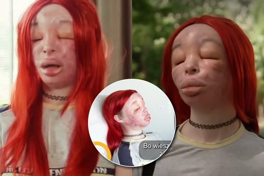 Po namuose atliktų injekcijų – siaubingos pasekmės: tai, ką sau į veidą leidosi lenkų translytė, sukrečia
