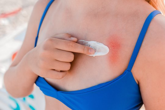 Vaistininkas paaiškino: odos būklė, kurią dažnas painioja su nudegimu saulėje
