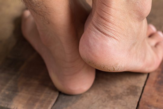 Skausmingi įtrūkimai kulnuose – ne tik grožio klausimas: kada kremo nebeužtenka?