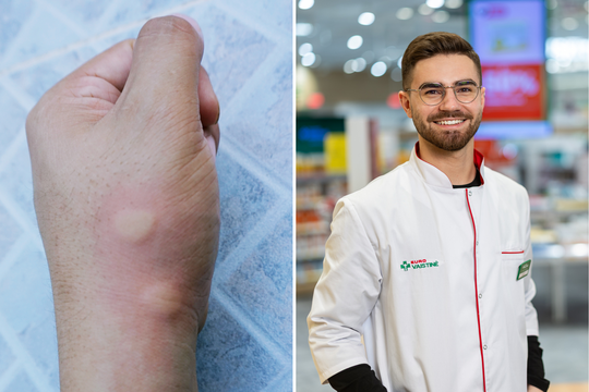 Vabzdžių įgėlimai: vaistininkas paaiškino, kada važiuoti į ligoninę