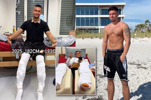 21-erių vokietis ryžosi rizikingai kojų ilginimo procedūrai: jo ūgio pokyčiai – neįtikėtini