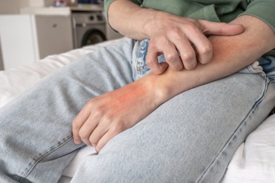 Skaudžiai geliančių sparvų išvengti sunkiau, nei uodų: kaip jas atbaidyti?