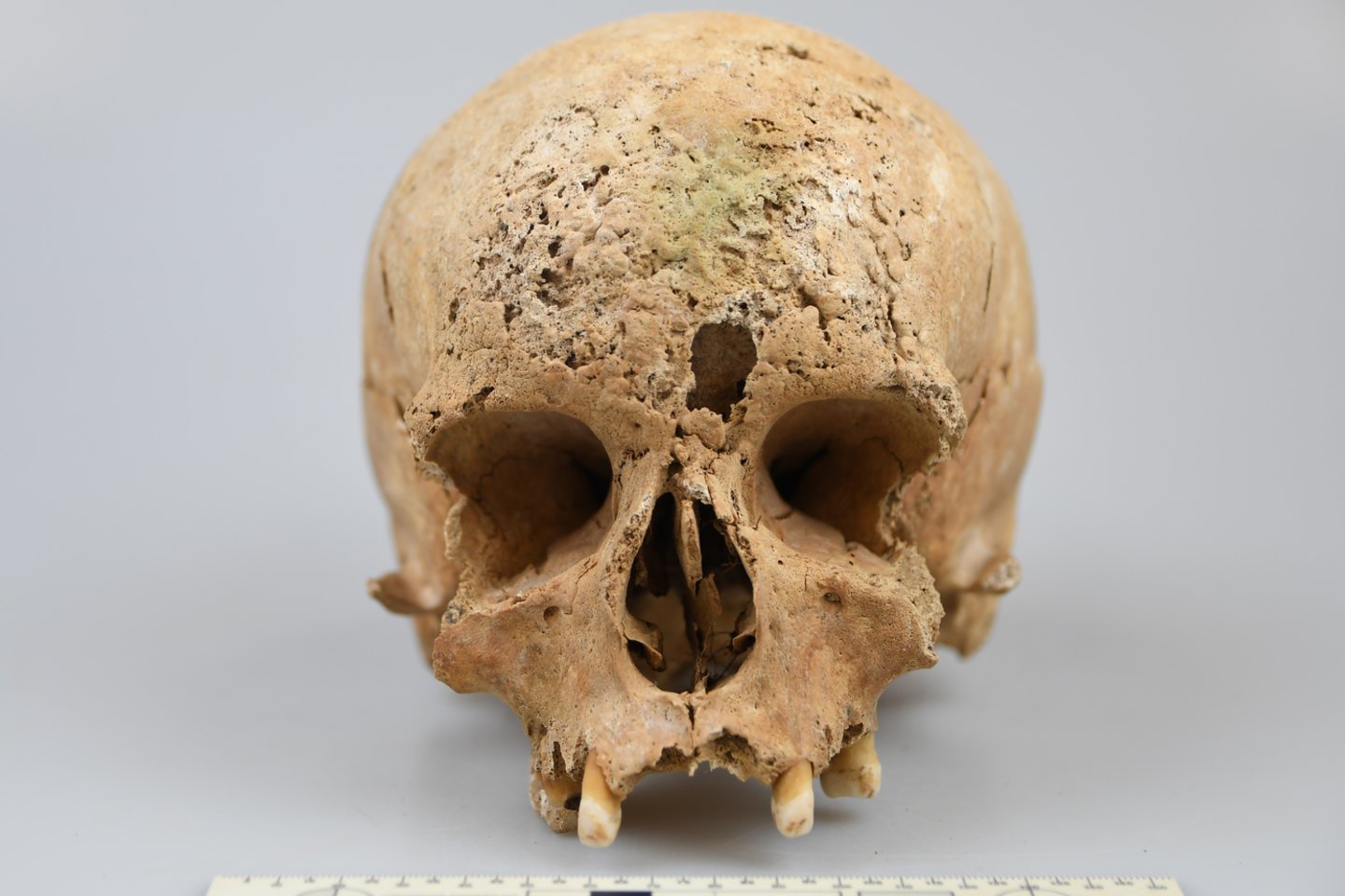 Evidence of tertiary syphilis in the skull of a young woman buried. at the Church of St Stephen in Vilnius<br>Photo by J. Kozakaitė.