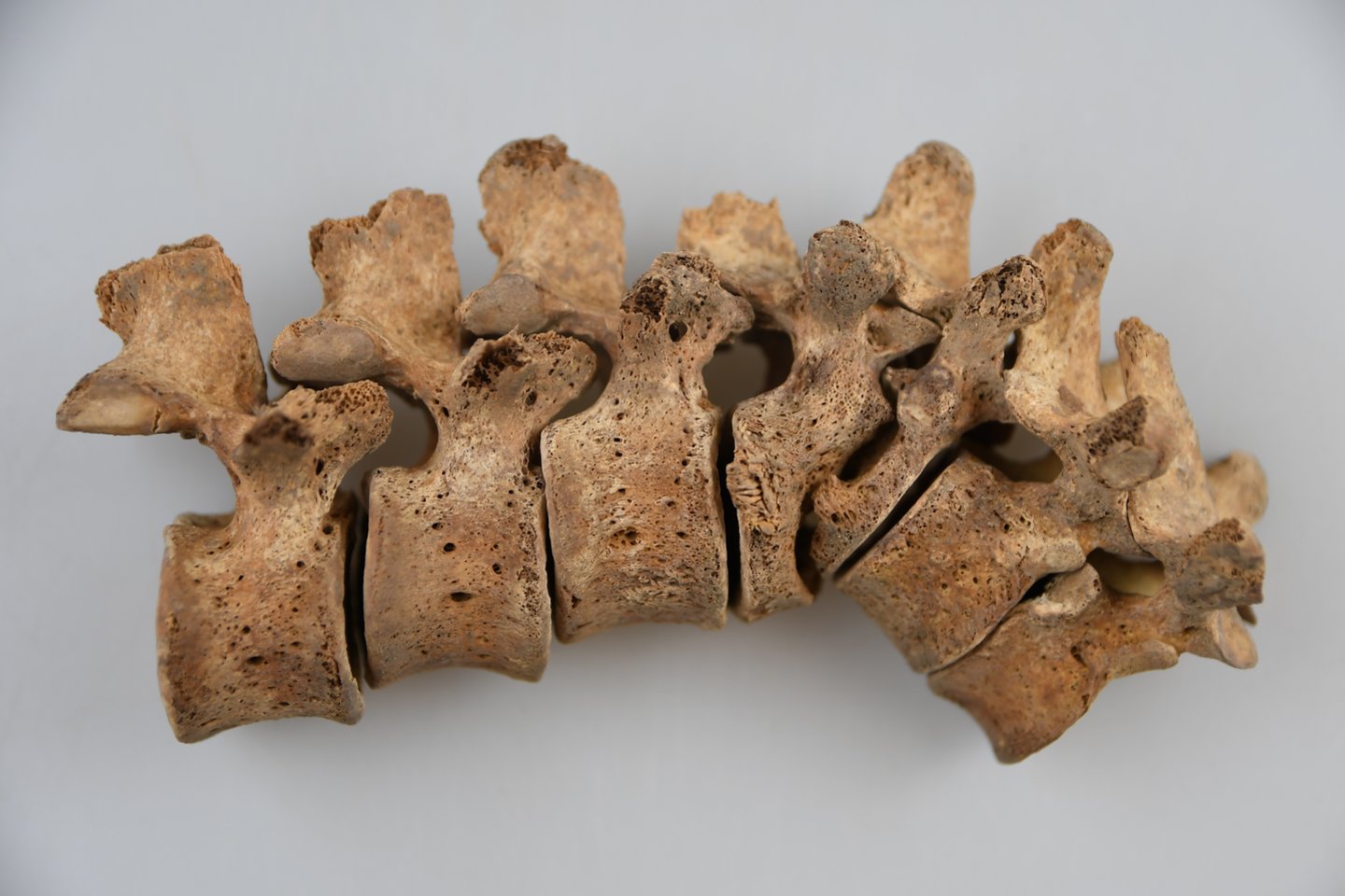 A young man spine affected by tuberculosis, Subačiaus Street 7.<br>Photo by J. Kozakaitė.