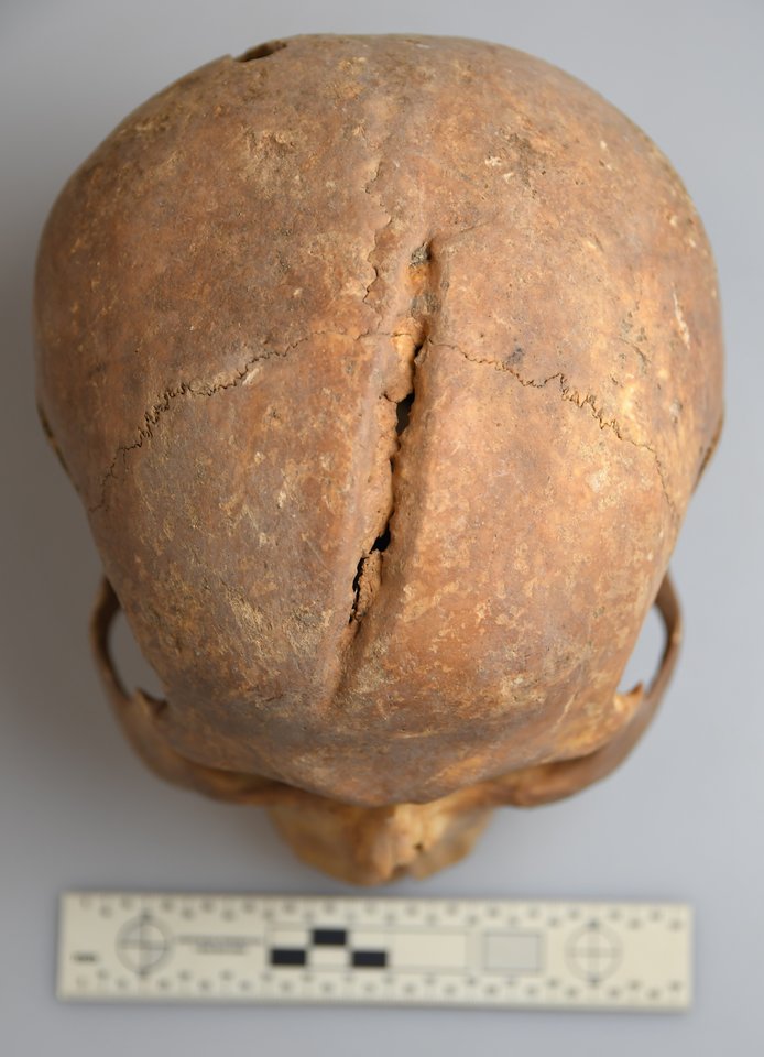A healed laceration on the top of the skull of an adult male located at Pranciškonų Street 1A.<br>Photo by J. Kozakaitė.