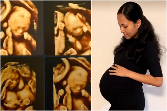 Tokia sėkmė pasitaiko kartą iš 15 milijonų: Australijoje gimė identiškos ketvertukės