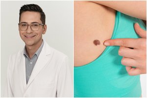 Odos vėžį išduoda ne tik apgamas: gydytojas patarė, kaip ligą pastebėti, kol dar nevėlu