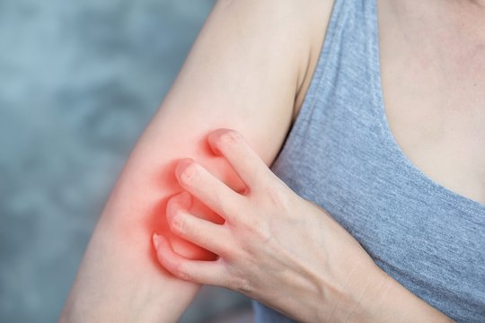 Niežti, tinsta ar skauda? Įkandimo žymė gali išduoti, kas jus sugėlė