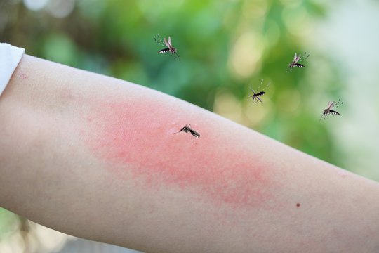 Tik įkandimas ar pavojinga alerginė reakcija? Gydytoja įvardijo požymius, kurių ignoruoti negalima
