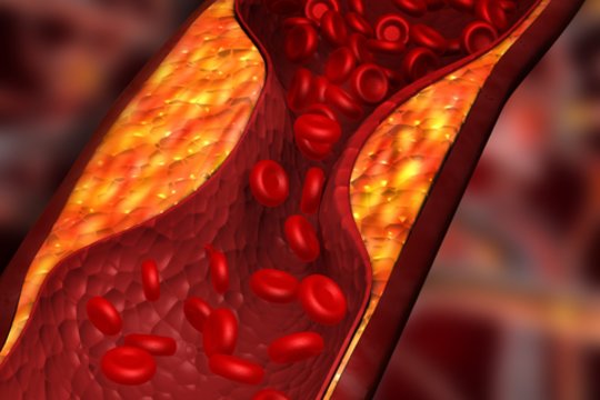 Lietuvoje bus pradėti kompensuoti nauji vaistai cholesterolio kiekiui mažinti