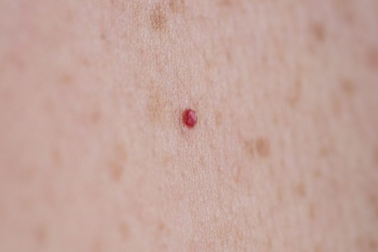 Maži raudoni taškeliai ant odos: ką jie reiškia?