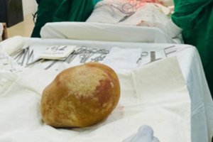 55-erių vyro kūne – pribloškiantis medikų radinys: akmuo svėrė kaip naujagimis
