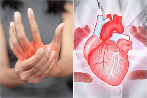Podagra – ne tik sąnarių skausmas: gydytojas perspėjo apie dar vieną grėsmę