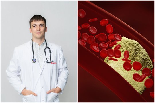 Valgote sveikai, sportuojate, bet cholesterolis vis tiek padidėjęs: medikas paaiškino, kas vyksta