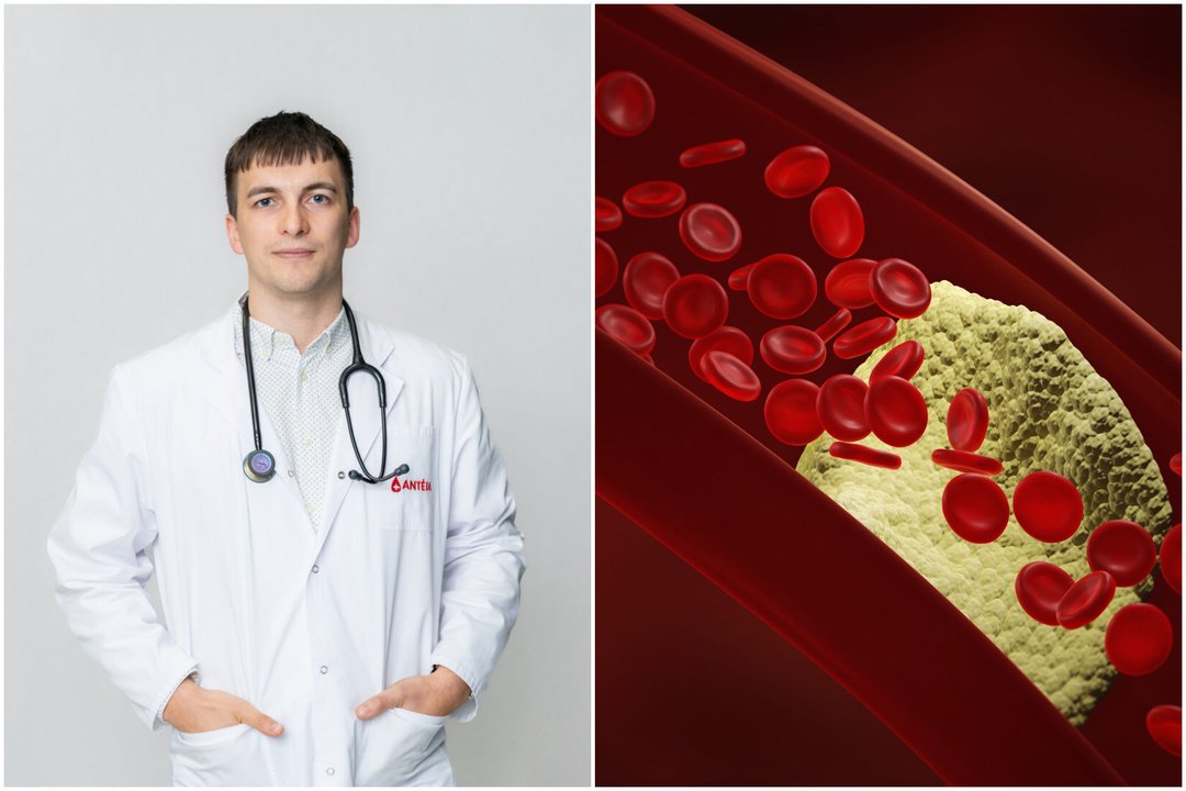 Valgote sveikai, sportuojate, bet cholesterolis vis tiek padidėjęs: medikas paaiškino, kas vyksta