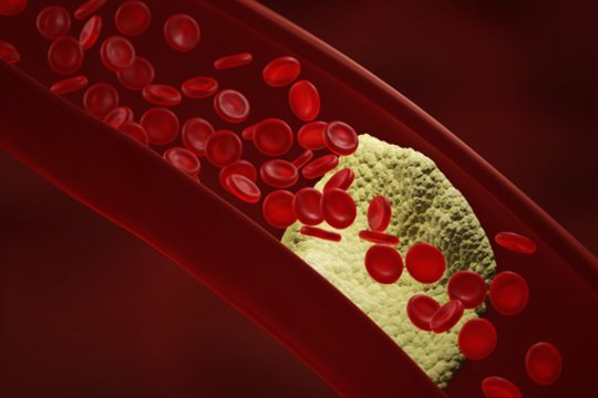 Turite padidėjusį cholesterolį? Šiuos 3 dalykus privalu padaryti vos pakilus iš lovos 