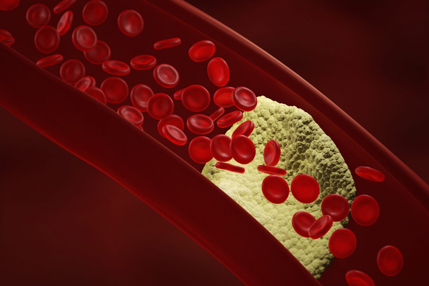 Aterosklerozė, padidėjęs cholesterolis.<br>Asociatyvi 123rf iliustr.