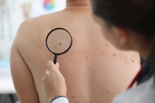 Po vasaros – nauji dariniai ant odos: kokie požymiai gali įspėti apie klastingą melanomą?