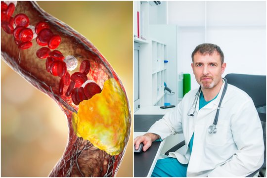 Cholesterolį galima sumažinti ir be statinų: kardiologas įvardijo geriausią metodą