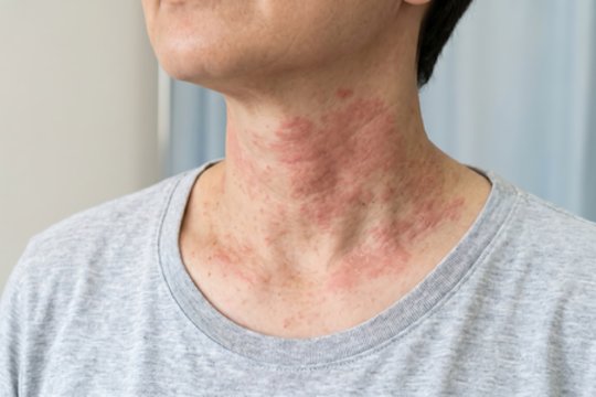 Kodėl rudenį paūmėja atopinis dermatitas? Patarė, kada kreiptis į gydytoją