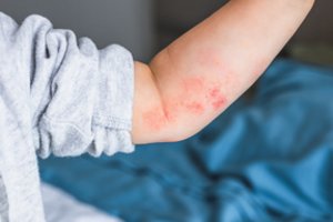 Atopinis dermatitas – našta ne tik odai: paaiškino, kaip liga paveikia kasdienį gyvenimą