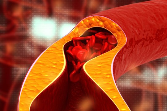 Cholesterolio kiekiui mažinti bus kompensuojami nauji vaistai
