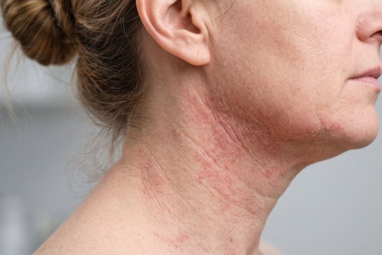Stresas ir oda: ar emocinė įtampa gali paskatinti atopinio dermatito paūmėjimą?