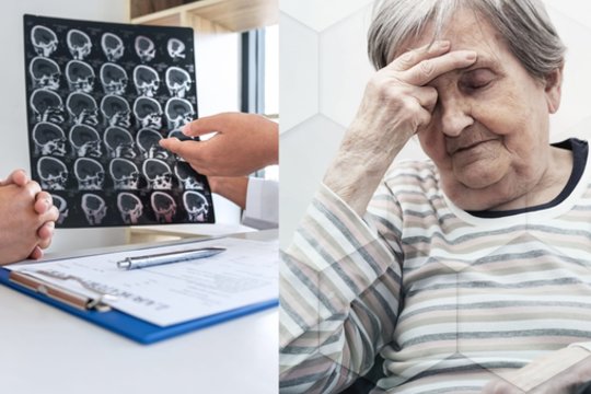 Organizmas apie insultą gali įspėti prieš mėnesį – štai į ką reikėtų atkreipti dėmesį