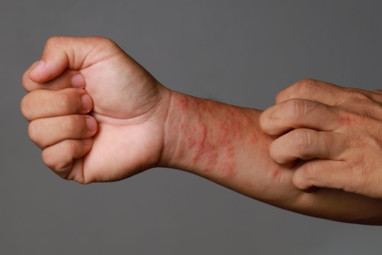 Maistas ir atopinis dermatitas: ar tikrai reikia atsisakyti pieno, kiaušinių ir kitų produktų?