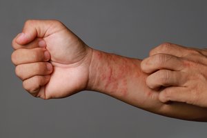 Maistas ir atopinis dermatitas: ar tikrai reikia atsisakyti pieno, kiaušinių ir kitų produktų?