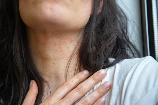 Atopinis dermatitas suaugusiesiems: kodėl liga gali sugrįžti net po daugelio metų?