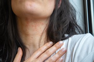 Atopinis dermatitas suaugusiesiems: kodėl liga gali sugrįžti net po daugelio metų?