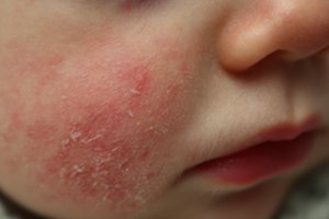 Atopinis dermatitas vaikams: kokius pirmuosius požymius turėtų pastebėti tėvai?